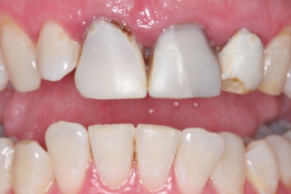 Discoloured and stained teeth before treatment