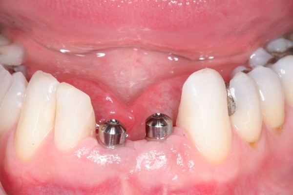 Before Dental Implant Treatment